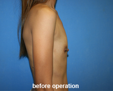 plastic-surgery-breast-augmentation
